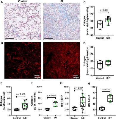 Adipose Stromal Cell-Secretome Counteracts Profibrotic Signals From IPF Lung Matrices